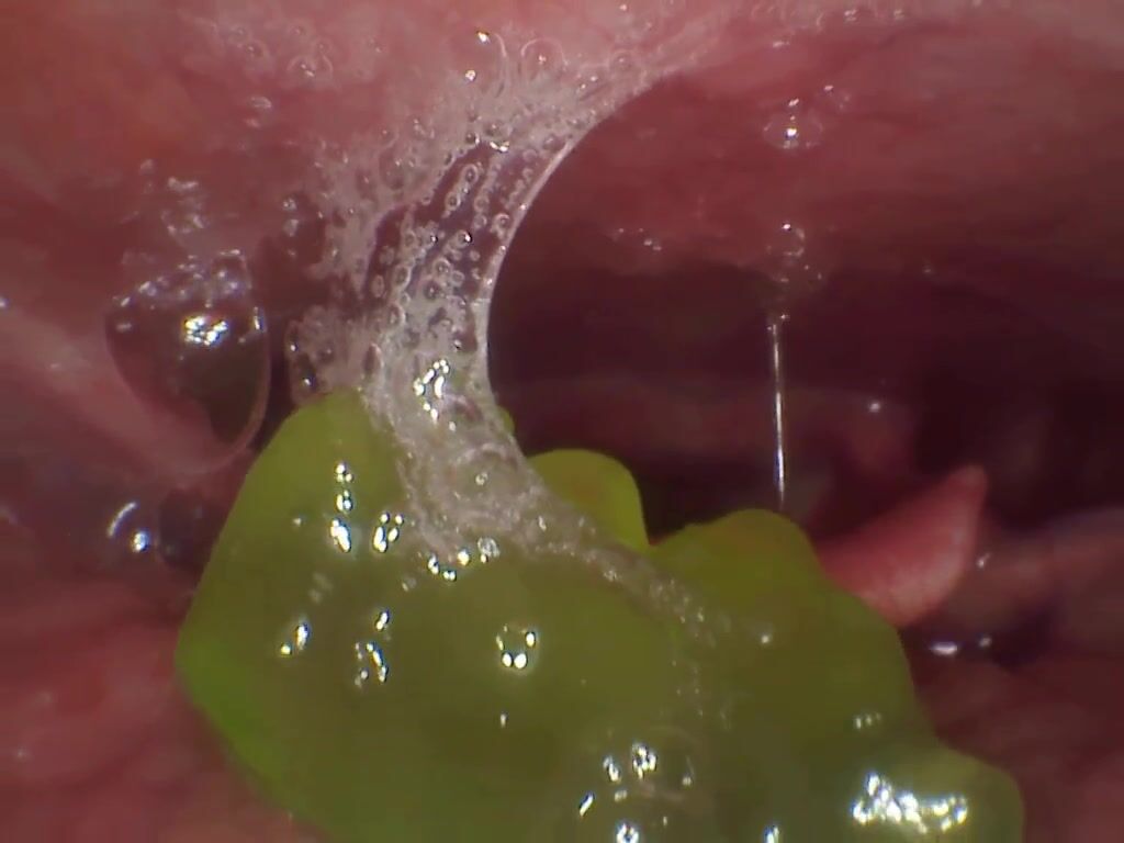 endoscope gummy